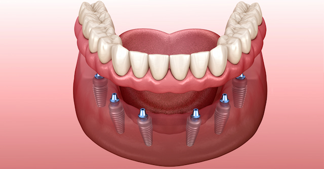 Desideri avere denti fissi?