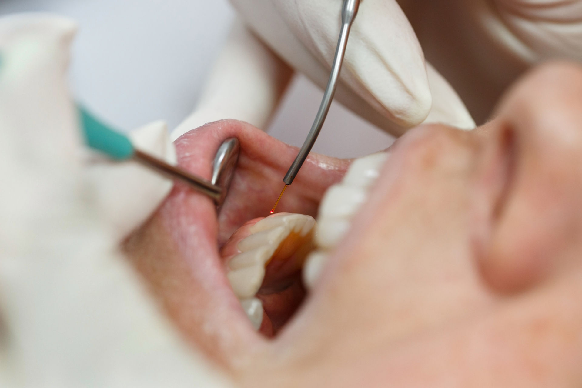 Dental laser