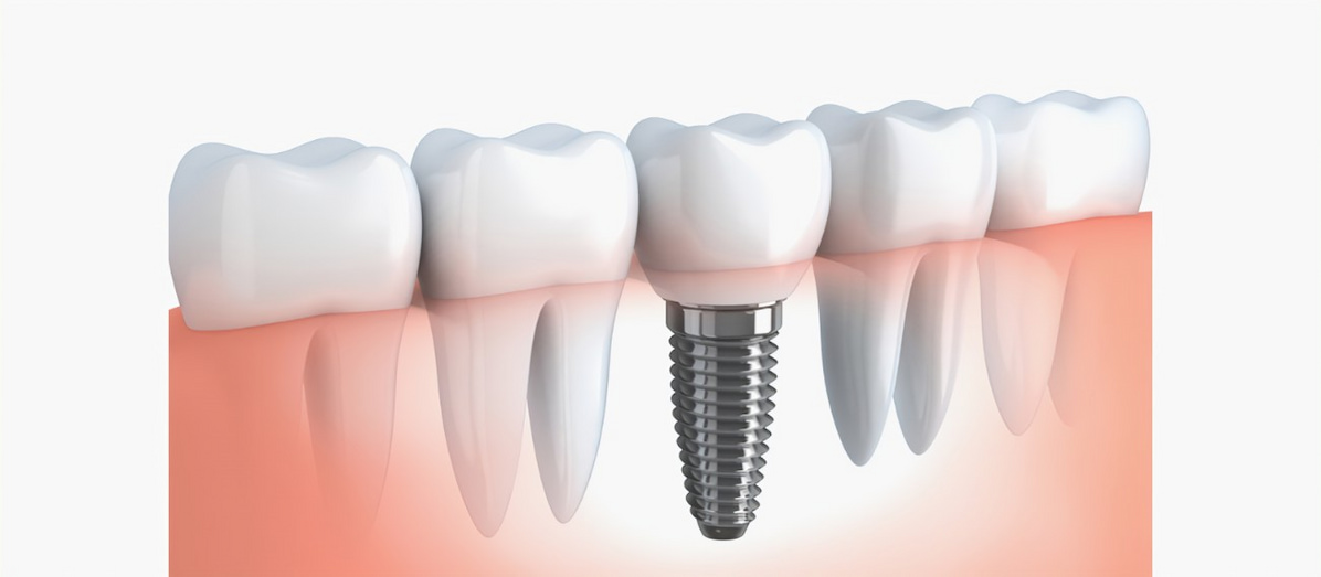 Implantologia dentale Cagliari