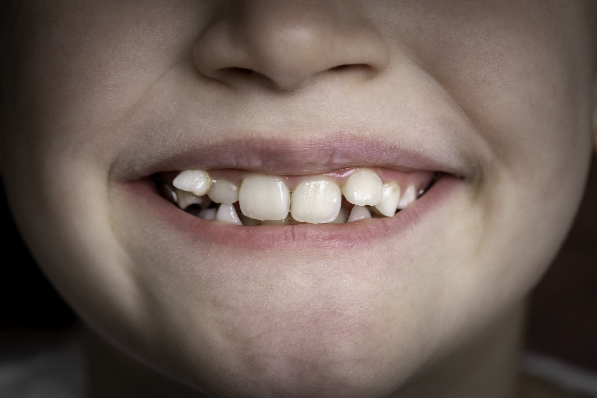 denti storti bambino